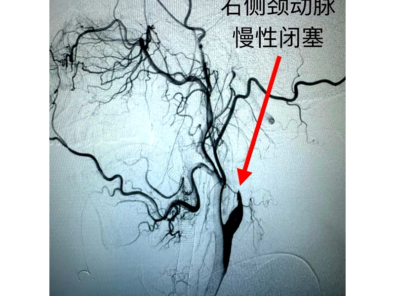 銅川礦務(wù)局中心醫(yī)院成功開展首例右側(cè)頸內(nèi)動脈慢性閉塞開通術(shù) ...